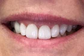 Porcelain-Veneers-After1