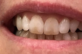 Porcelain-Veneers-Before1